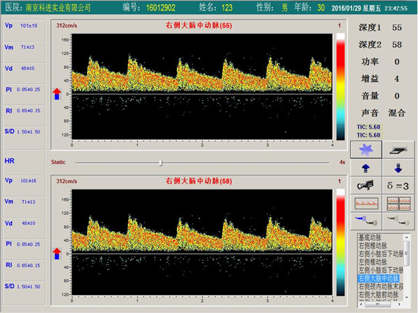 經顱多普勒單通道，雙深度界面