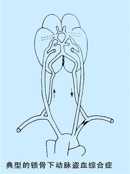 1533014591248744.jpg 典型的鎖骨下動脈盜血綜合癥圖.jpg
