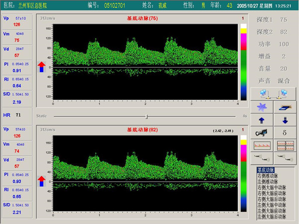 1533193056890208.jpg 超聲經顱多普勒血流分析儀雙窗口(雙通道或雙深度)檢測界面.jpg