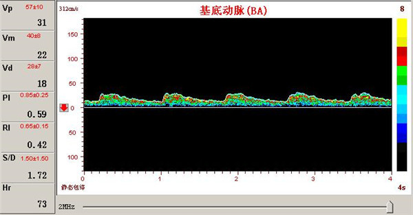 經顱多普勒檢測椎基底動脈供血障礙的表現