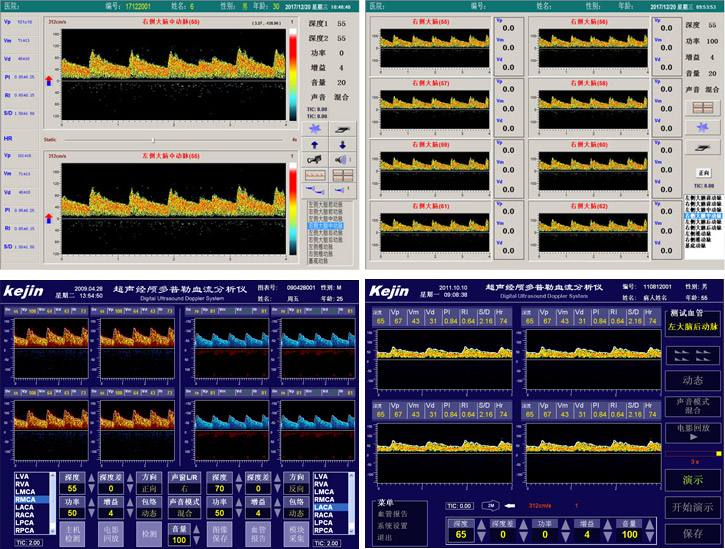 TCD血管定位技術(shù)實(shí)現(xiàn)自動(dòng)搜索血管信號(hào) TCD血管定位技術(shù)實(shí)現(xiàn)自動(dòng)搜索血管信號(hào)