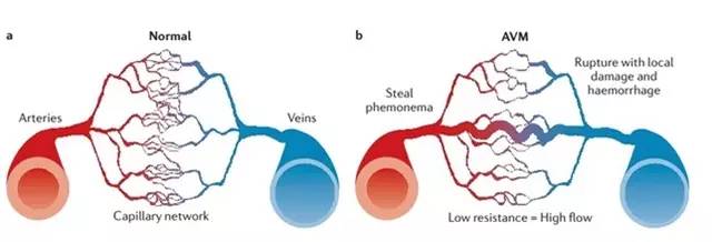 腦動(dòng)靜脈畸形(AVM)的經(jīng)顱多普勒表現(xiàn) 腦動(dòng)靜脈畸形(AVM)的經(jīng)顱多普勒表現(xiàn)