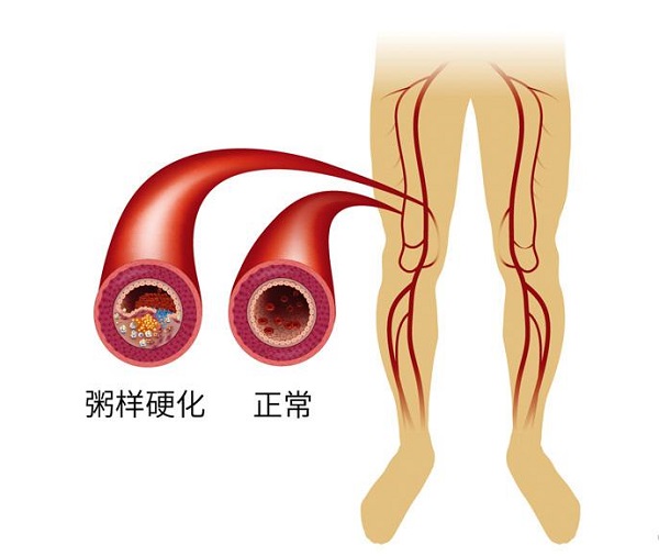 如何減緩腦動脈粥樣硬化的發生和發展 如何減緩腦動脈粥樣硬化的發生和發展