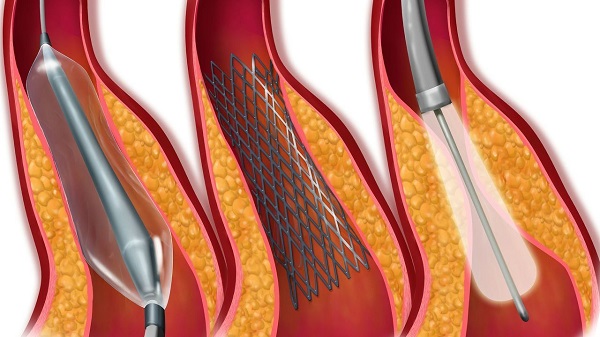 哪些檢查方法可以發現腦動脈狹窄 哪些檢查方法可以發現腦動脈狹窄